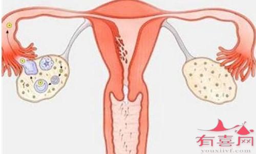 湛江借卵试管助孕群-当一个女人缺少一个卵巢时会发生什么？
