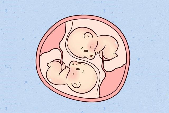 多胎妊娠减少_多胎妊娠_足月胎儿心音正常
