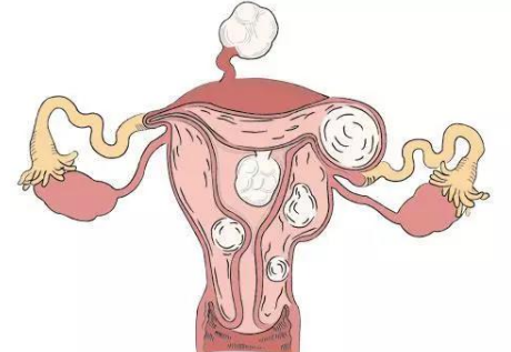 昆明助孕qq群：多发性子宫肌瘤影响女性健康，如何控制和预防？