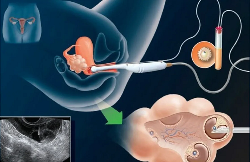厦门助孕机构套餐：试管婴儿胚胎移植后是否有必要进行强有力的营养补充？